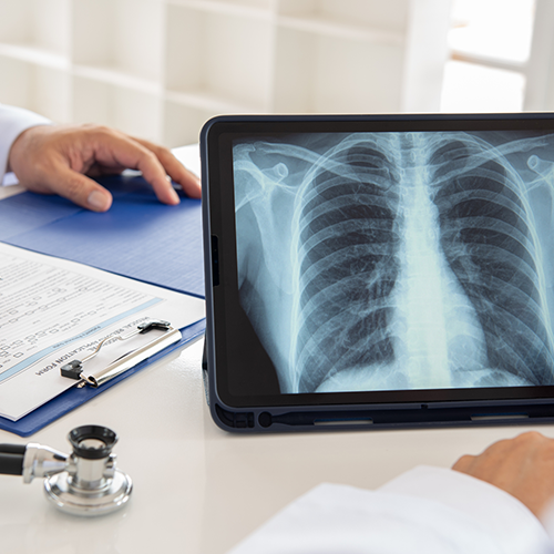The Power of Early Detection: How Lung Cancer Screenings Can Save Lives